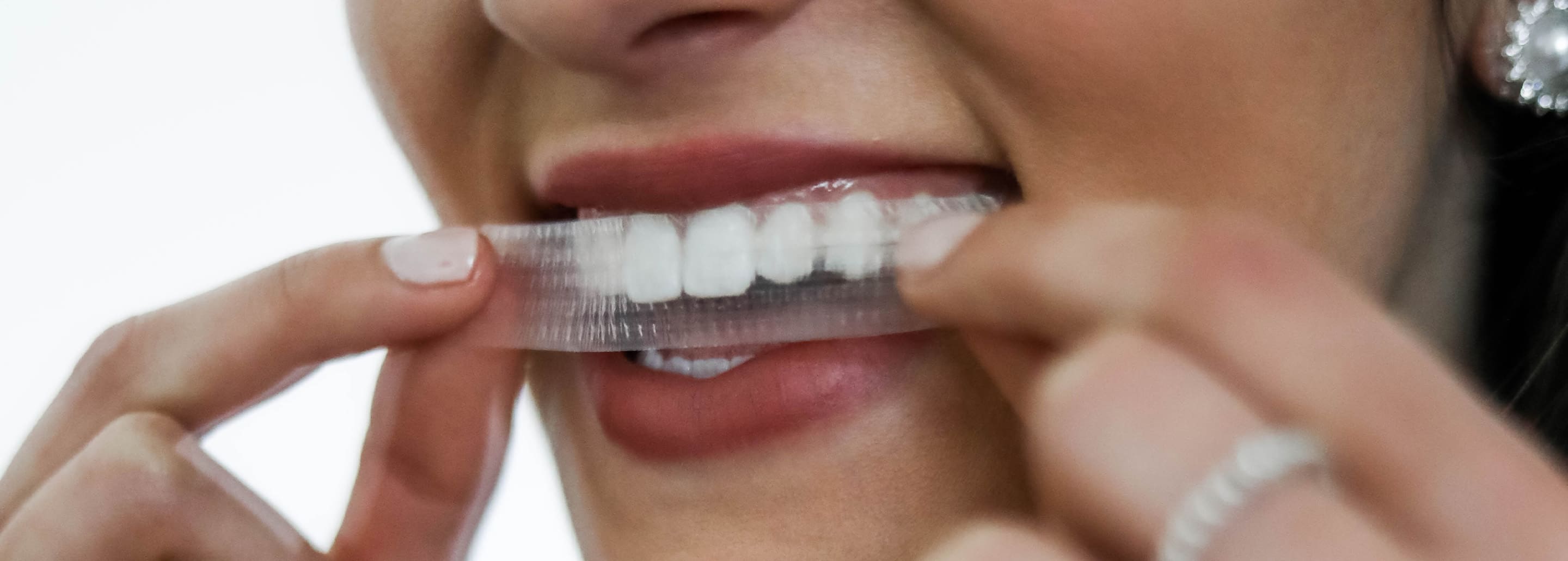 Affordable Teeth Whitening Options