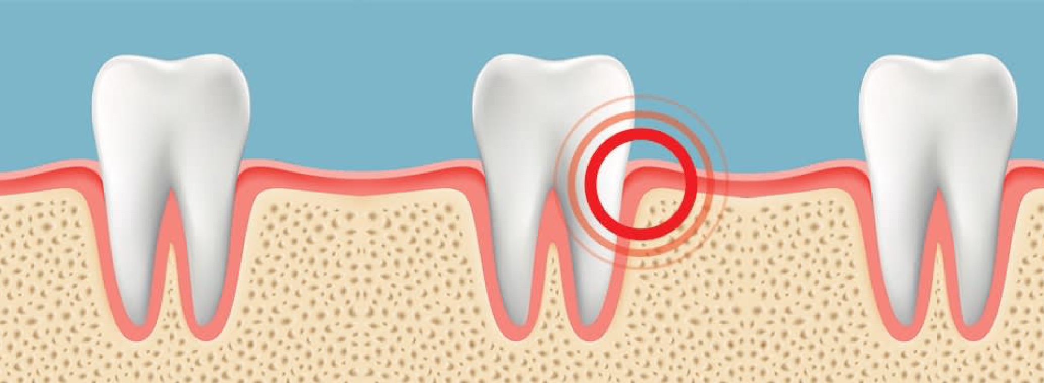 Canker Sore On Upper Gum