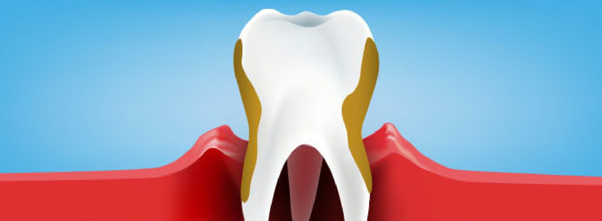 periodontitis