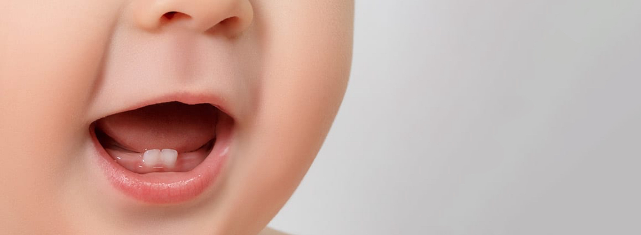 decalcification in baby teeth