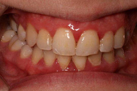 Gum Disease Pictures: What do Healthy Gums Look Like? - Crest