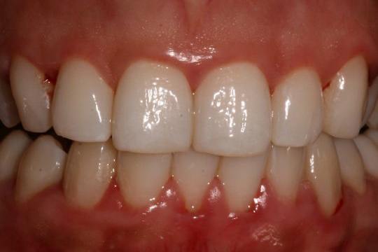 charcoal and gum disease