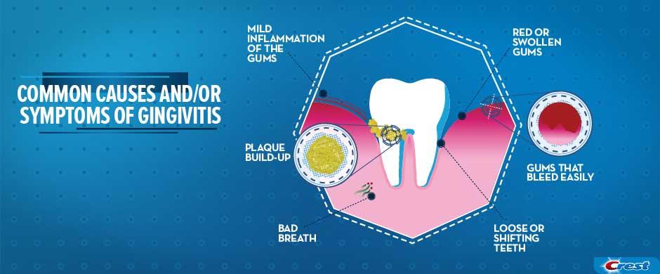 Common Causes and Symptoms of Gingivitis