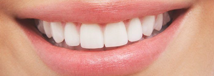 How Much Does Teeth Whitening Cost
