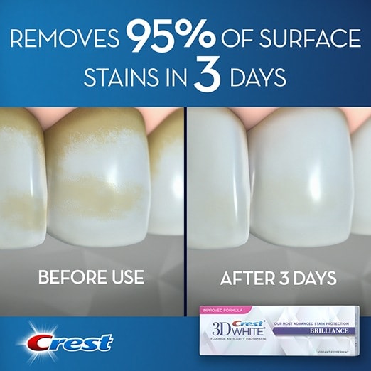 The before and after view of removing 95% of teeth stains with Crest 3D White toothpaste